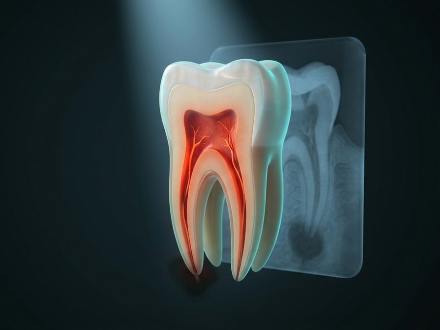 Ilustración: corte de un molar con la pulpa inflamada, junto a la radiografía del mismo diente