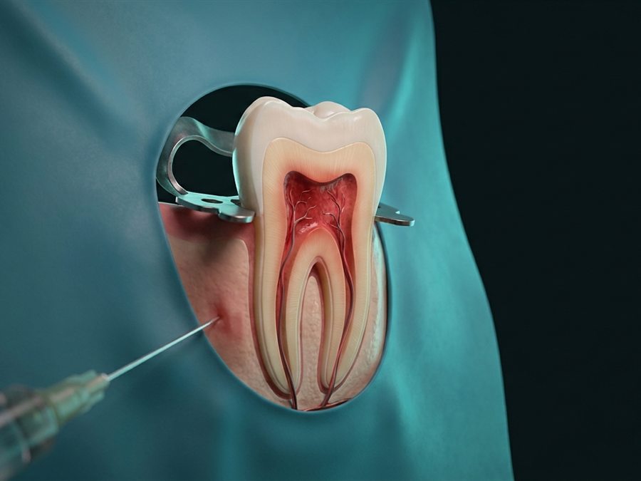 Ilustración: molar aislado con goma dique y clamp mientras se aplica la anestesia
