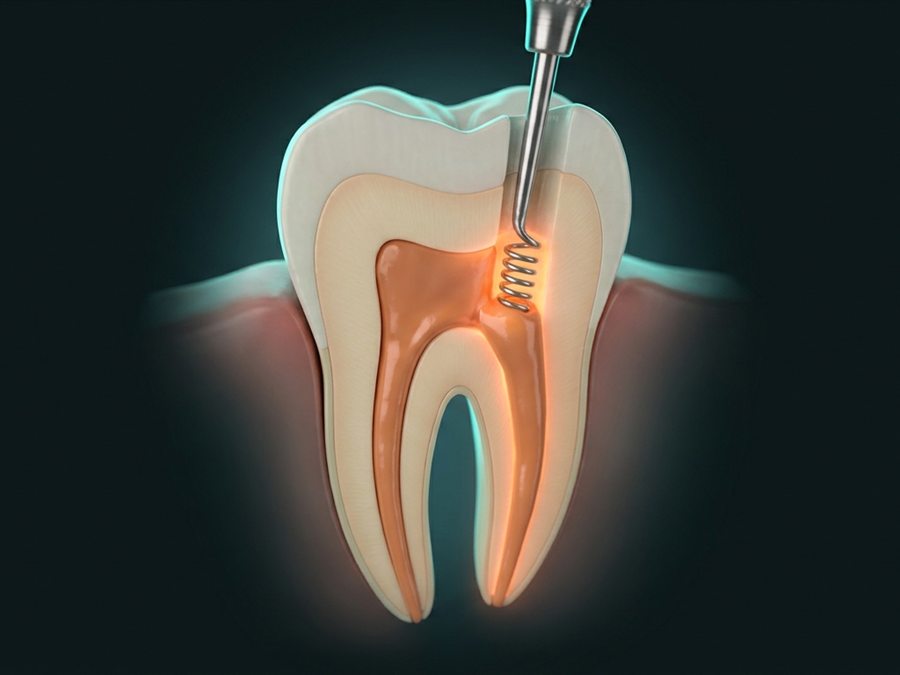 Ilustración: gutapercha termoplástica sellando el conducto de un molar hasta el ápice