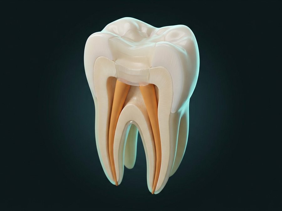 Ilustración: molar con los dos conductos sellados y la corona ya reconstruida